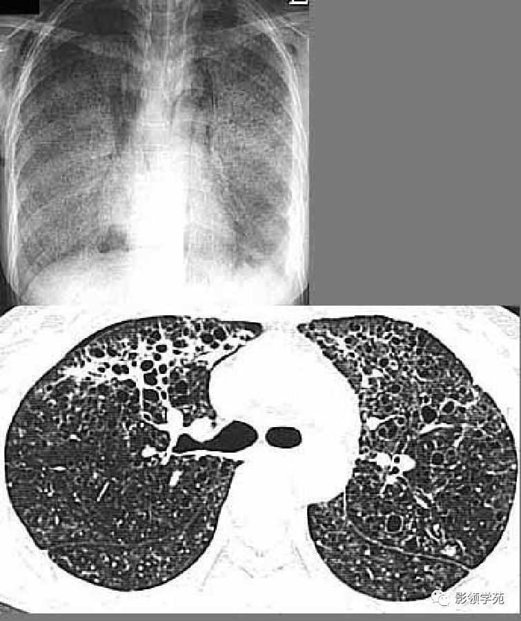 肺脓肿空洞图片