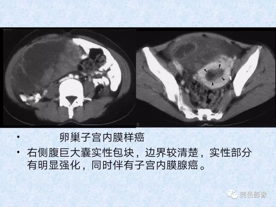 卵巢纤维瘤ct影像表现