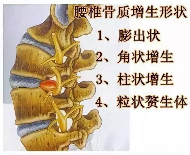 中国腰椎病患者已突破2亿它和骨质增生有区别吗