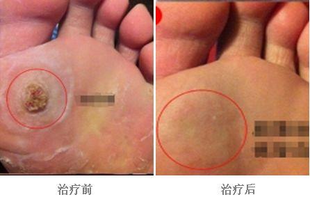 我院用激光治疗"鸡眼"效果好