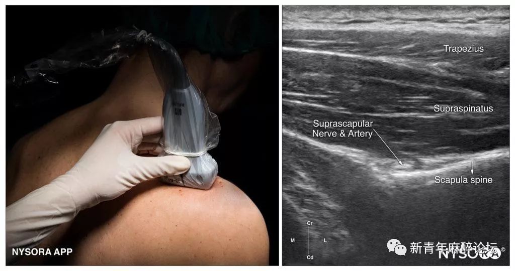 超声引导肩胛上神经和腋神经阻滞(科普)