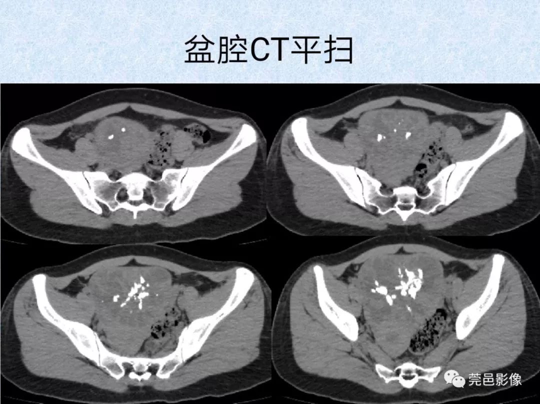 卵巢纤维瘤ct影像表现