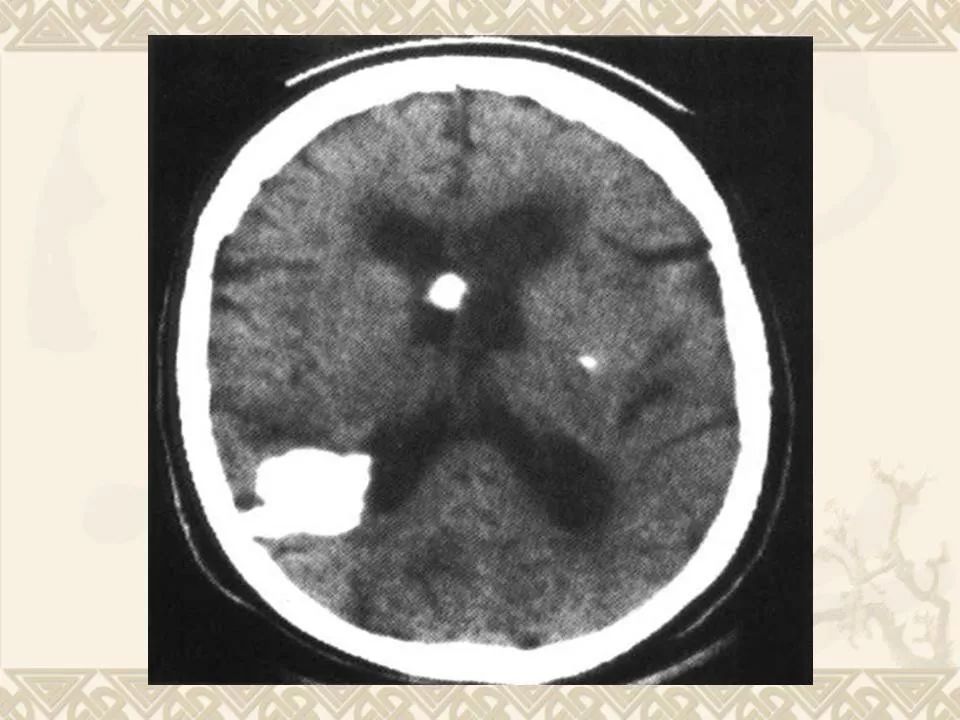 侧脑室脉络丛钙化图片