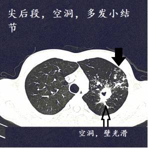 肺结核肺癌ct图片图解图片