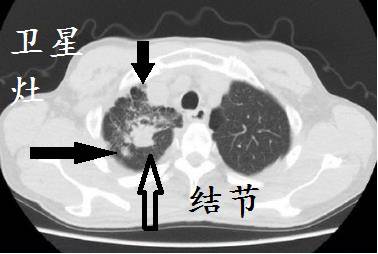 尖段结节,周围卫星病灶.9淋巴结结核,为什么?