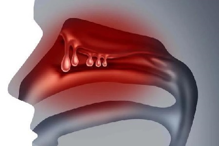 首大陈潜如何判断鼻子里长了息肉