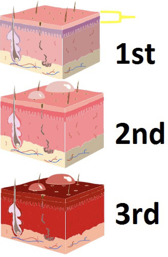 遇到烧伤,烫伤,应该立刻离开热源,避免情况进一步恶化;接着,可以对