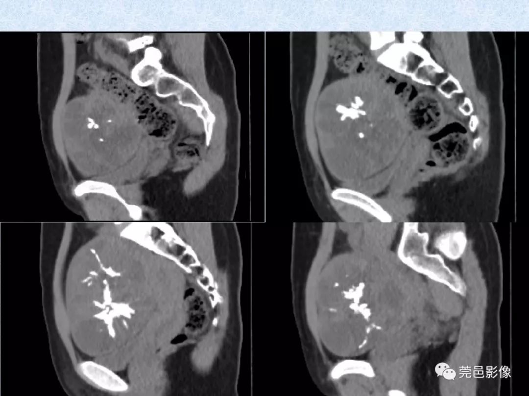卵巢纖維瘤ct影像表現