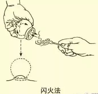 拔罐疗法你了解多少