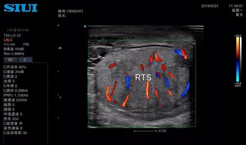 附睾超声图片