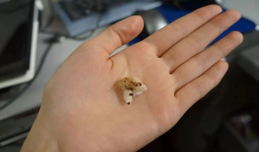 的分泌,这会使耳朵内部看起来很脏,有的耳垢会非常多,还会呈现油性