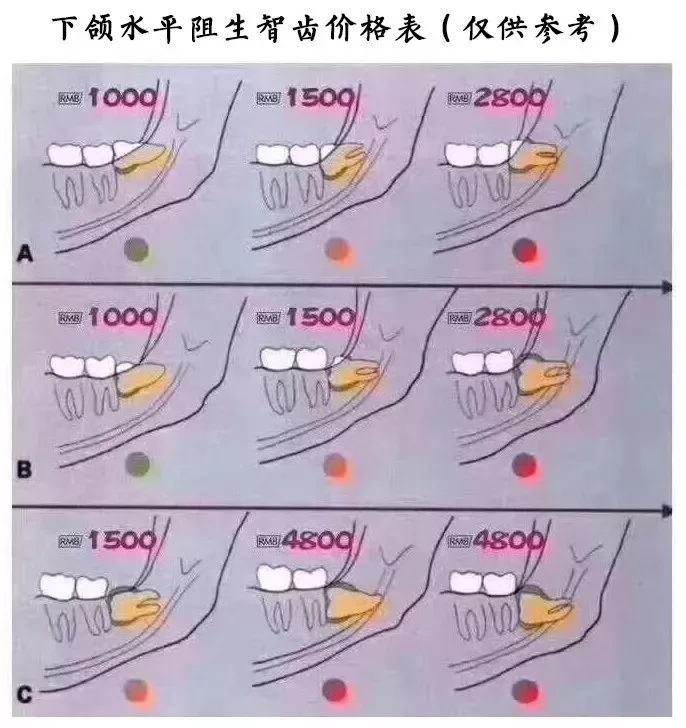 拔智齿全过程图片