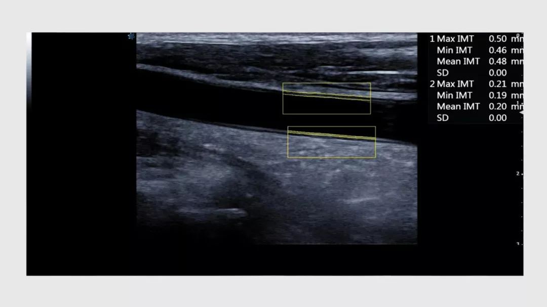 颈动脉斑块超声图片图片