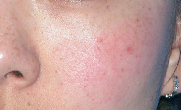 修复敏感肌去除红血丝怎么管理效果最好