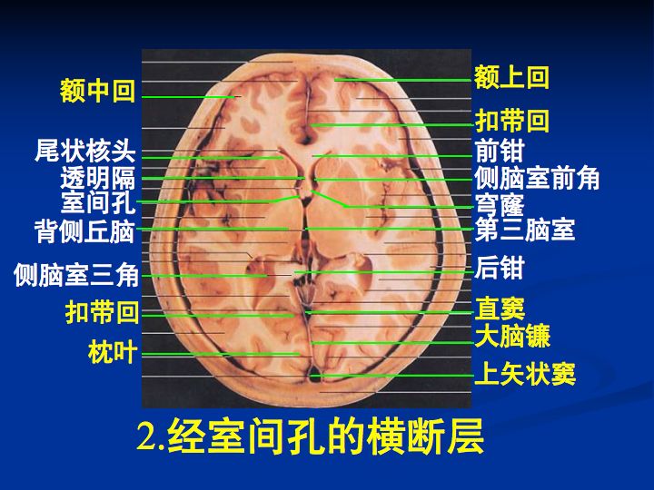 神经解剖脑室系统解剖及第三脑室病变常见手术入路南昌大学一附院徐春