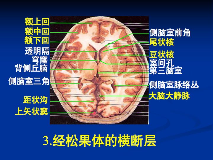 侧脑室与第三脑室图解图片