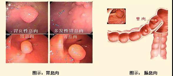 胃肠|西安马应龙肛肠医院夏航校院长：胃肠息肉都会癌变吗？