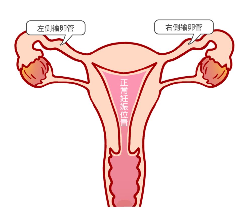 输卵管图片 宫外孕图片