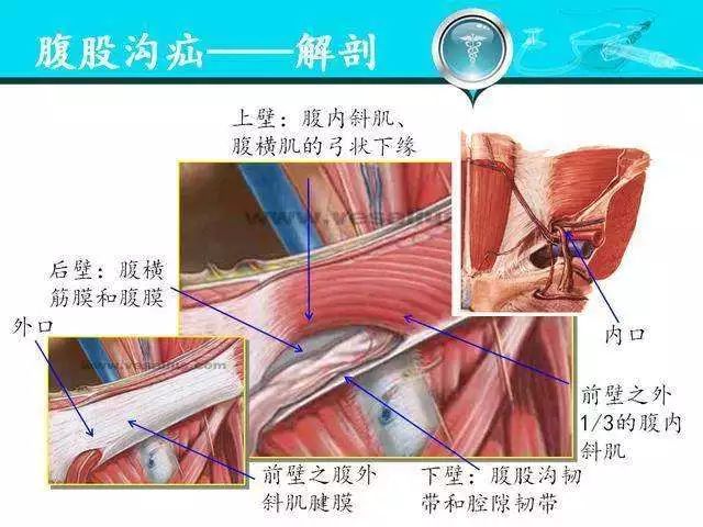 腹腔镜疝气修补术图解图片