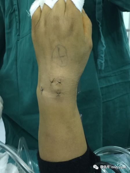 微创手术,切口细小对于腕关节的三角纤维软骨复合体(tfcc)损伤,腕关节