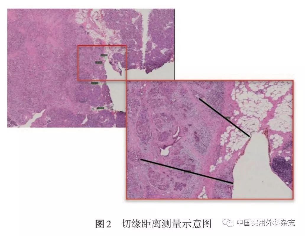 自2010年后,胰腺癌病理学检查逐步标准和规范,leeds病理学方法(leeds