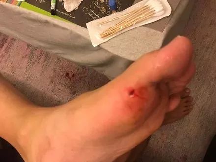 男子睡觉中被狗狗咬伤,他不仅不责骂,还一直维护着狗狗!