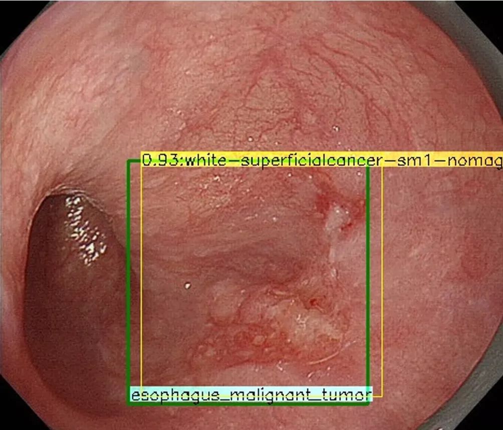 食管鱗癌浸潤深度評估人工智能vs資深內鏡醫師實力大pk消化客