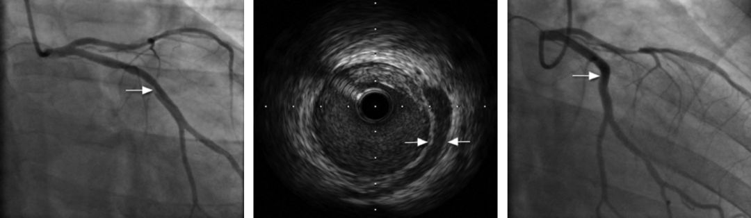 IVUS看世界①|冠状动脉自发夹层，是少见病么？-搜狐大视野-搜狐新闻