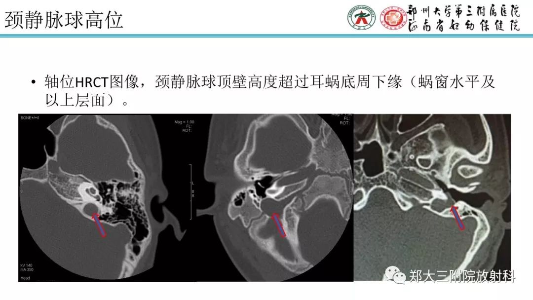 顳骨解剖及外中耳畸形的影像診斷