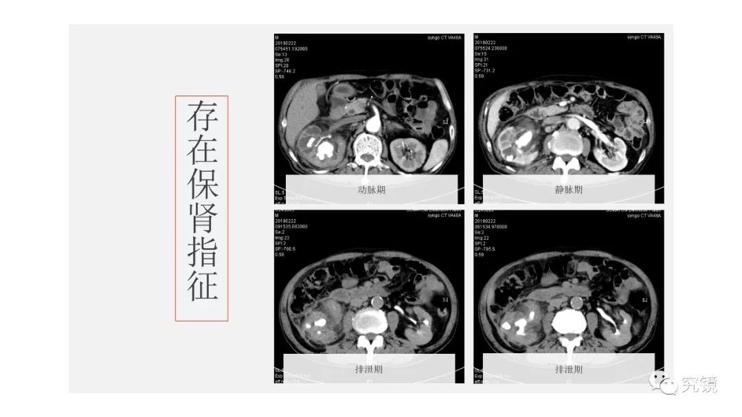 126号作品:治疗铸型结石合并肾积脓一例