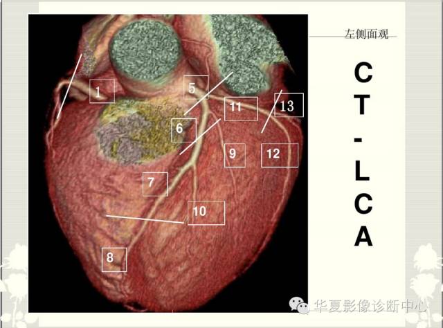 詳細瞭解冠脈解剖及分段