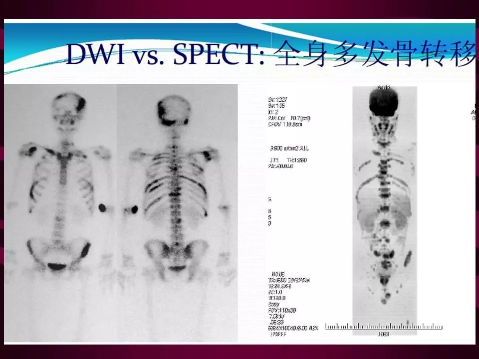 骨转移瘤的影像诊断