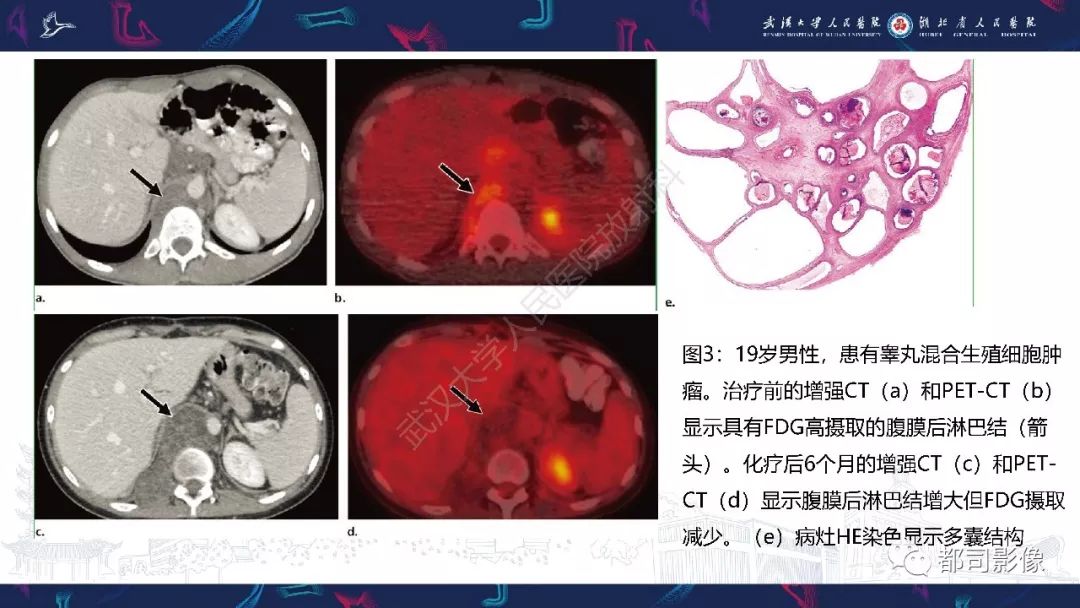 生殖细胞瘤能结婚吗男女有区别吗的简单介绍-第1张图片-鲸幼网