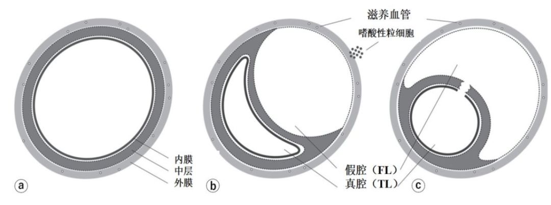 IVUS看世界①|冠状动脉自发夹层，是少见病么？-搜狐大视野-搜狐新闻