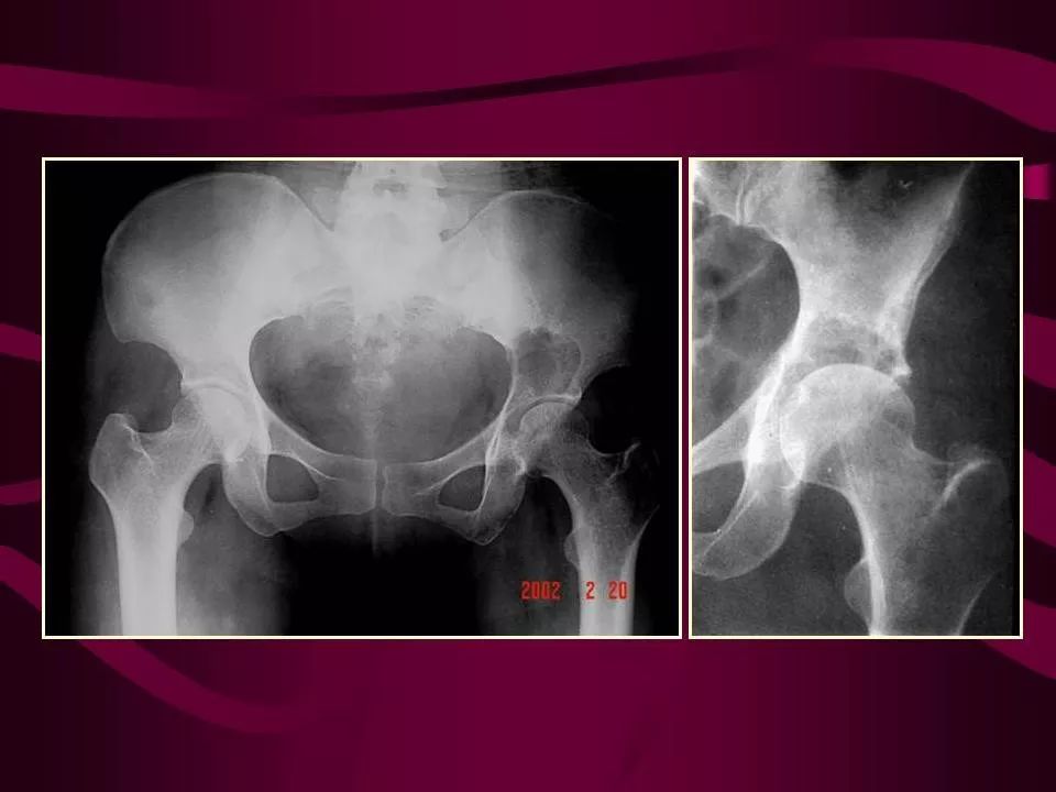 骨转移瘤的影像诊断