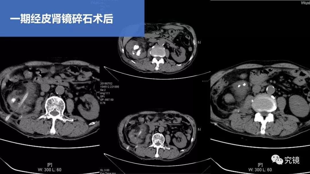 126号作品:治疗铸型结石合并肾积脓一例