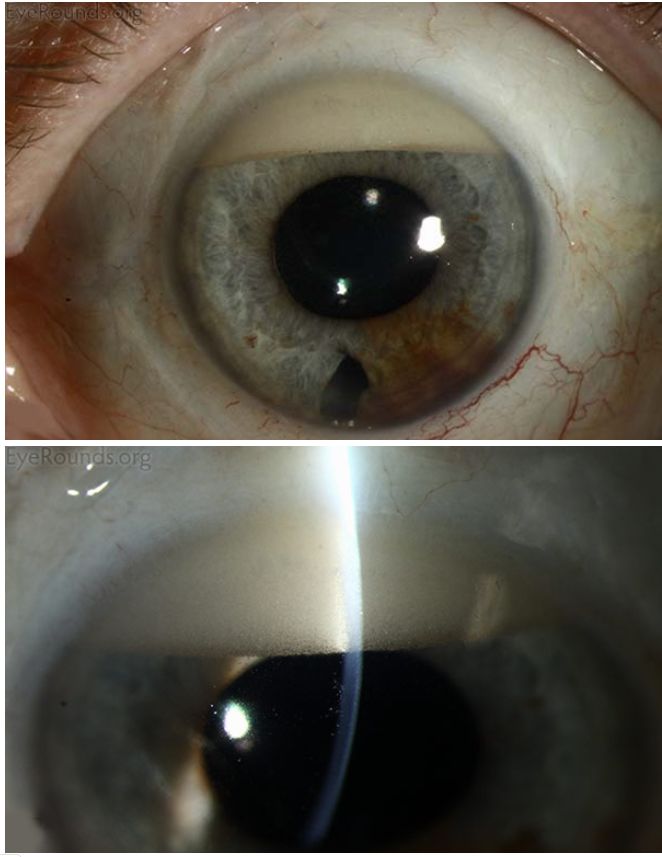 多变的黄斑变性不变的小分子疗效