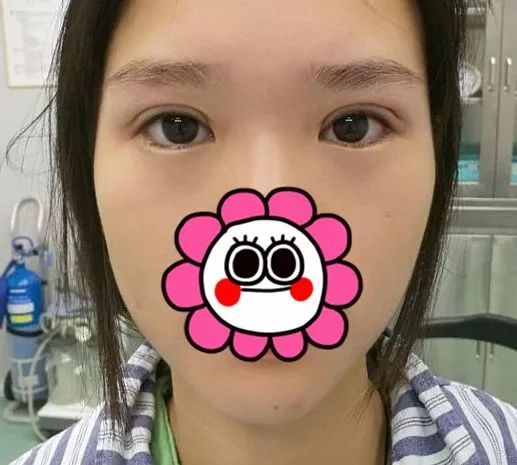 窄了不明显宽了太夸张双眼皮割多宽才好看