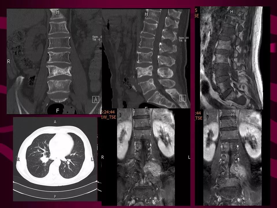 骨癌ct图片