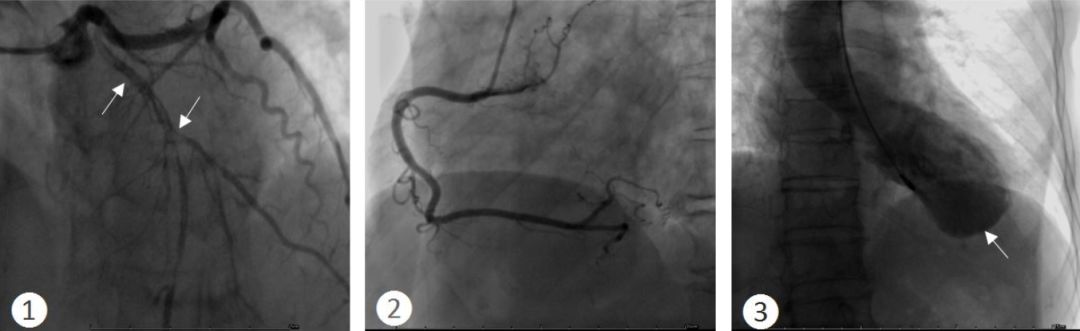 IVUS看世界①|冠状动脉自发夹层，是少见病么？-搜狐大视野-搜狐新闻