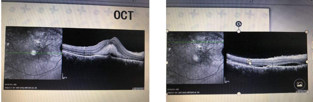 治疗后一个月眼底彩照小分子治疗后一个月oct治疗前octa治疗前ffa治疗