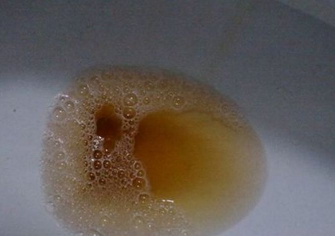 的代谢,从而让胆红素进入血液的机会增加,导致排出的尿液颜色加深