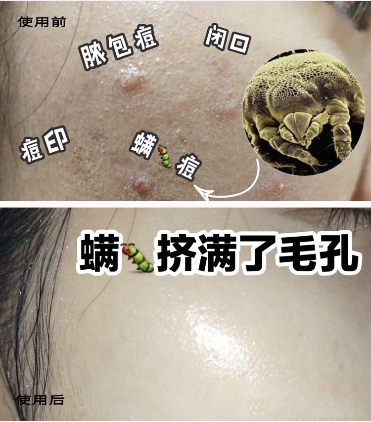 螨虫脸治疗方法图片