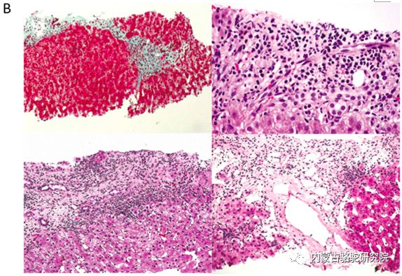 增加,伴有輕度小葉壞死性炎症,f2級門靜脈和局灶性間隔纖維化(圖1b)