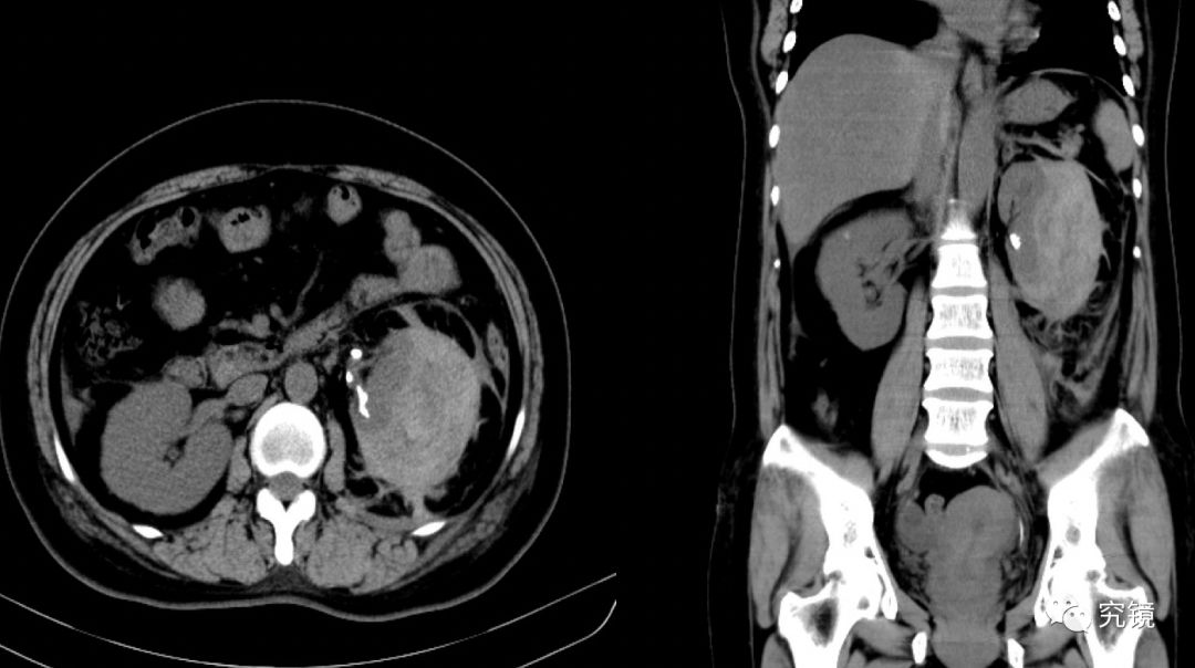 136号作品:输尿管镜钬激光碎石术后肾包膜血肿原因探讨_手术