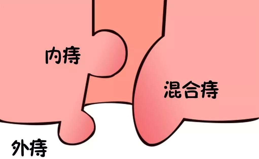 痔疮动画演示图片