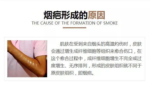 陈思诚曾给佟丽娅烫烟疤烟头烫伤如何处理会不会留疤