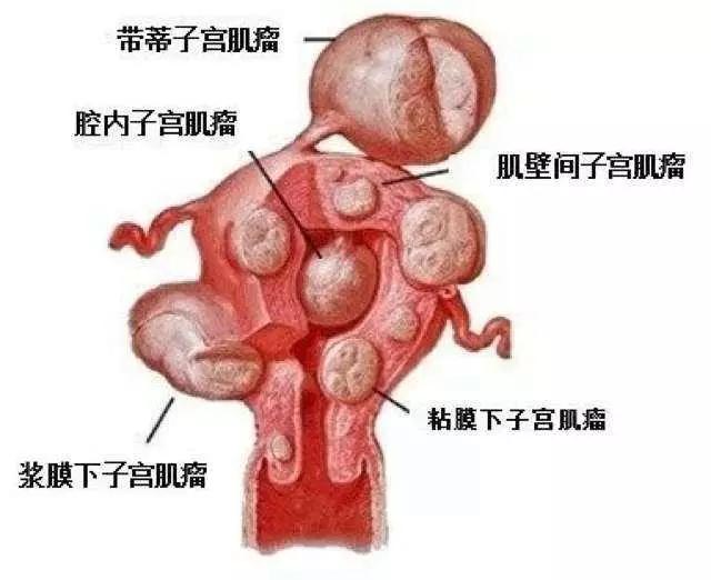 子宫肌瘤关键要养肝