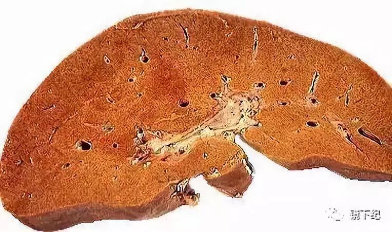 纪小龙脂肪肝不是病担心烦恼均多余