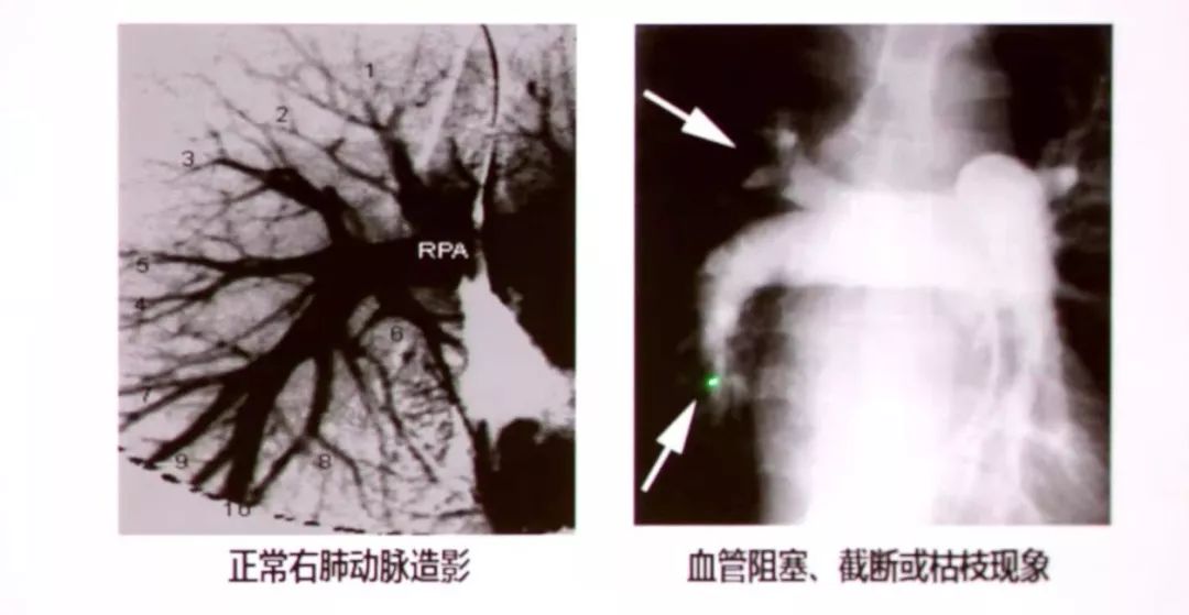 图为:肺动脉造影